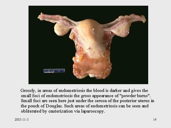 Grossly, in areas of endometriosis the blood is darker and gives the small foci