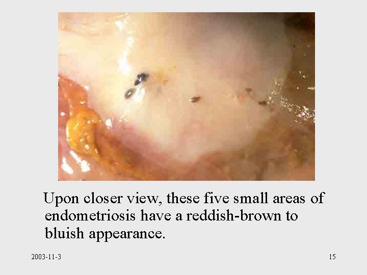 Upon closer view, these five small areas of endometriosis have a reddish-brown to bluish