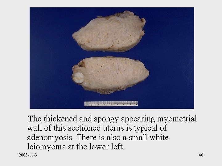 The thickened and spongy appearing myometrial wall of this sectioned uterus is typical of