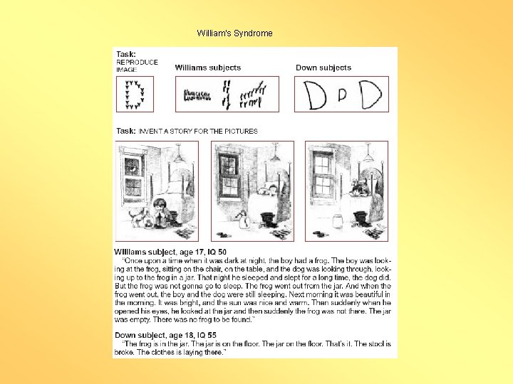 William’s Syndrome 