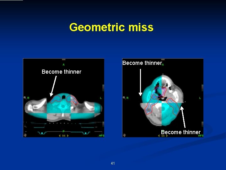 Geometric miss Become thinner 41 