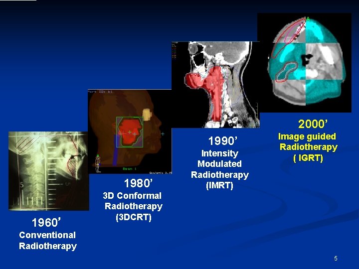 2000’ 1990’ 1980’ 1960’ Intensity Modulated Radiotherapy (IMRT) Image guided Radiotherapy ( IGRT) 3