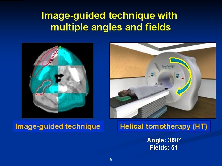 Image-guided technique with multiple angles and fields Image-guided technique Helical tomotherapy (HT) Angle: 360°