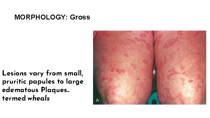 MORPHOLOGY: Gross Lesions vary from small, pruritic papules to large edematous Plaques. . termed