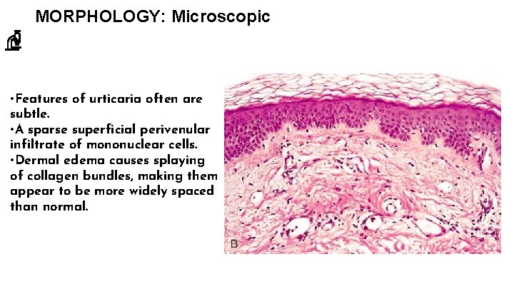 MORPHOLOGY: Microscopic • Features of urticaria often are subtle. • A sparse superficial perivenular