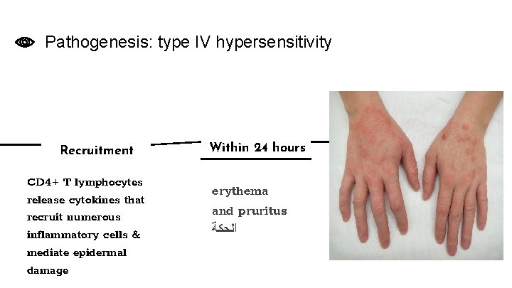 Pathogenesis: type IV hypersensitivity Recruitment CD 4+ T lymphocytes release cytokines that recruit numerous