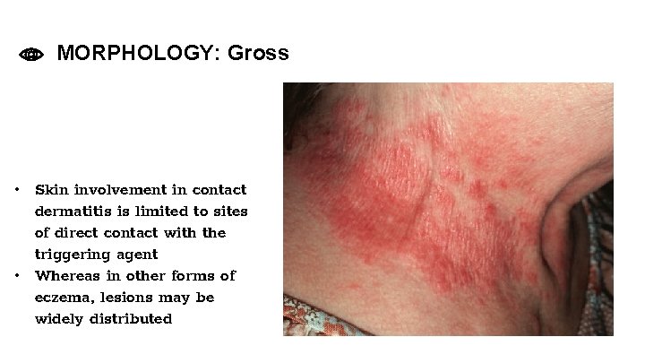 MORPHOLOGY: Gross • Skin involvement in contact dermatitis is limited to sites of direct