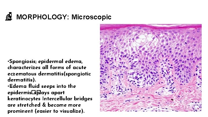 MORPHOLOGY: Microscopic • Spongiosis; epidermal edema, characterizes all forms of acute eczematous dermatitis(spongiotic dermatitis).