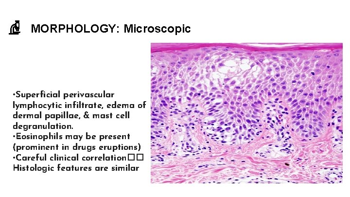 MORPHOLOGY: Microscopic • Superficial perivascular lymphocytic infiltrate, edema of dermal papillae, & mast cell