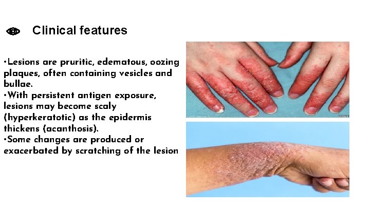 Clinical features • Lesions are pruritic, edematous, oozing plaques, often containing vesicles and bullae.