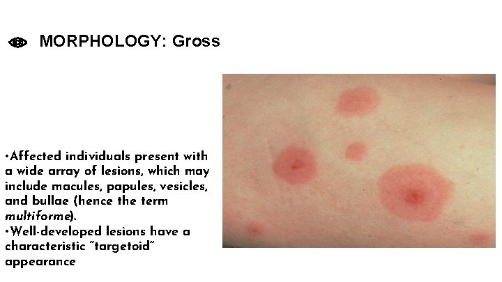 MORPHOLOGY: Gross • Affected individuals present with a wide array of lesions, which may