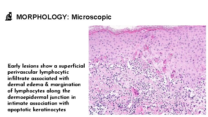MORPHOLOGY: Microscopic Early lesions show a superficial perivascular lymphocytic infiltrate associated with dermal edema