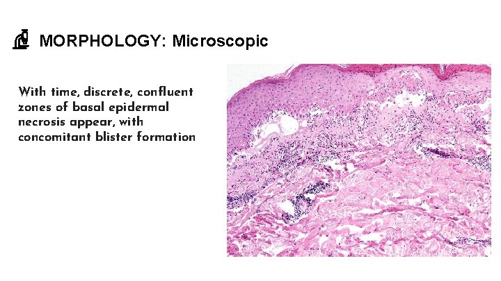 MORPHOLOGY: Microscopic With time, discrete, confluent zones of basal epidermal necrosis appear, with concomitant