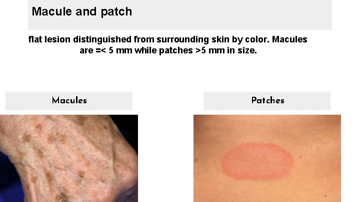 Macule and patch flat lesion distinguished from surrounding skin by color. Macules are =<