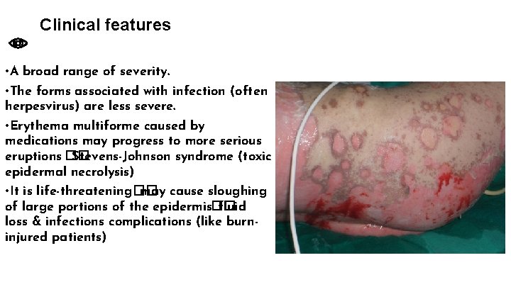 Clinical features • A broad range of severity. • The forms associated with infection