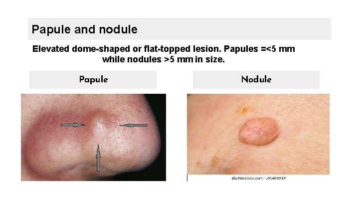 Papule and nodule Elevated dome-shaped or flat-topped lesion. Papules =<5 mm while nodules >5
