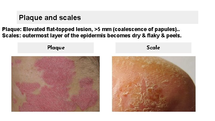 Plaque and scales Plaque: Elevated flat-topped lesion, >5 mm (coalescence of papules). . Scales: