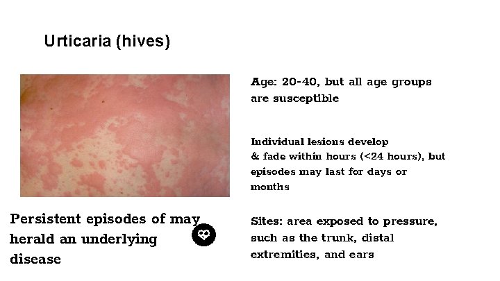 Urticaria (hives) Age: 20 -40, but all age groups are susceptible Individual lesions develop