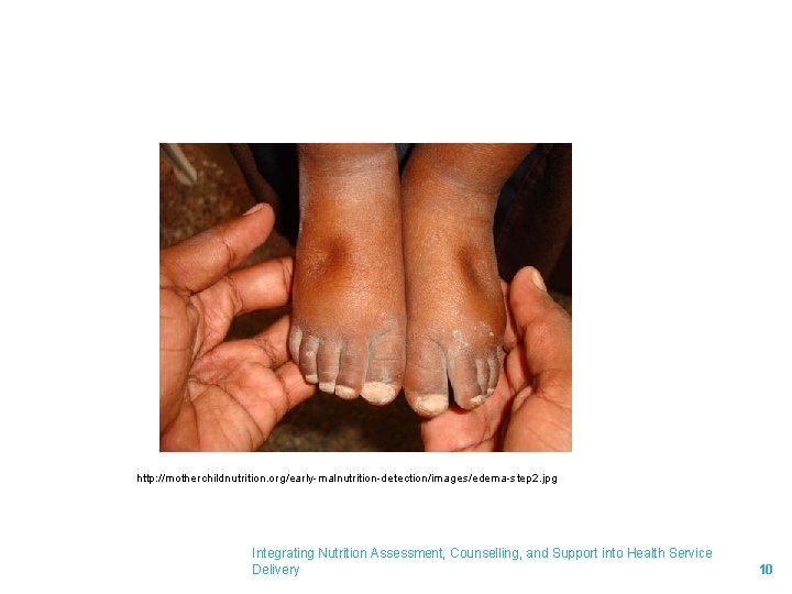 http: //motherchildnutrition. org/early-malnutrition-detection/images/edema-step 2. jpg Integrating Nutrition Assessment, Counselling, and Support into Health Service