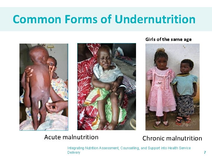 Common Forms of Undernutrition Girls of the same age Acute malnutrition Chronic malnutrition Integrating