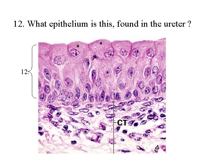 12. What epithelium is this, found in the ureter ? 12. 