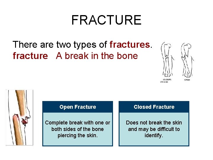 FRACTURE There are two types of fractures. fracture A break in the bone Open