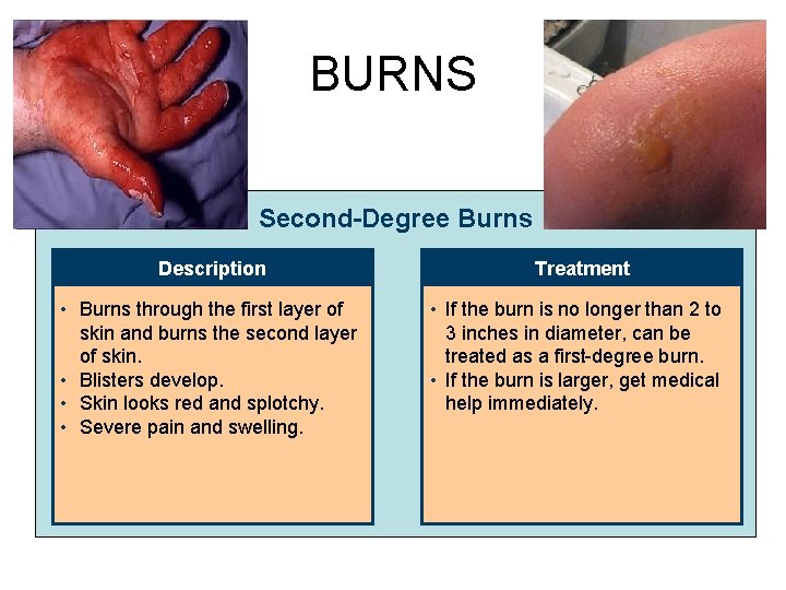 BURNS Second-Degree Burns Description • Burns through the first layer of skin and burns