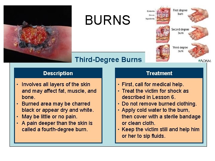 BURNS Third-Degree Burns Description Treatment • Involves all layers of the skin and may