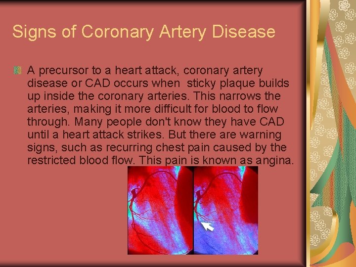 Signs of Coronary Artery Disease A precursor to a heart attack, coronary artery disease