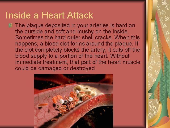 Inside a Heart Attack The plaque deposited in your arteries is hard on the