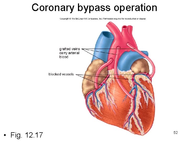 Coronary bypass operation • Fig. 12. 17 52 