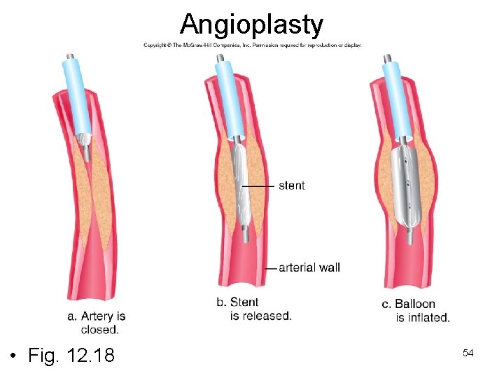 Angioplasty • Fig. 12. 18 54 