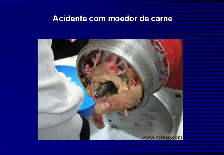 Acidente com moedor de carne 