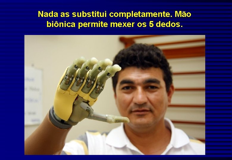 Nada as substitui completamente. Mão biônica permite mexer os 5 dedos. 