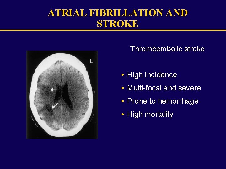 ATRIAL FIBRILLATION AND STROKE Thrombembolic stroke • High Incidence • Multi-focal and severe •