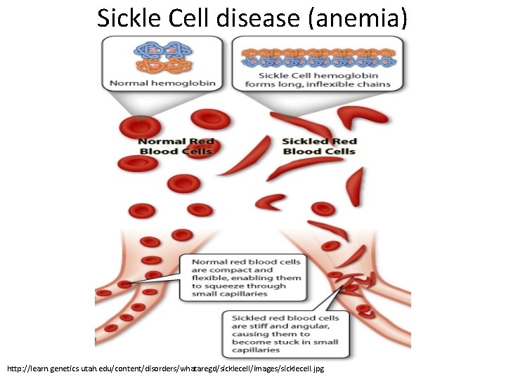 Sickle Cell disease (anemia) http: //learn. genetics. utah. edu/content/disorders/whataregd/sicklecell/images/sicklecell. jpg 