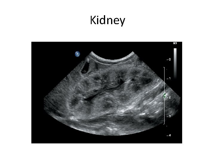 Kidney 