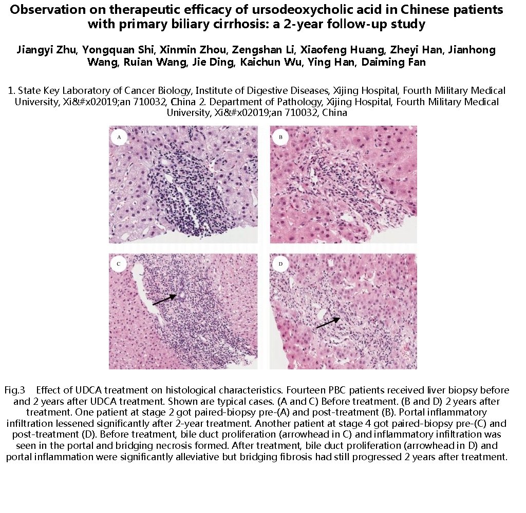 Observation on therapeutic efficacy of ursodeoxycholic acid in Chinese patients with primary biliary cirrhosis: