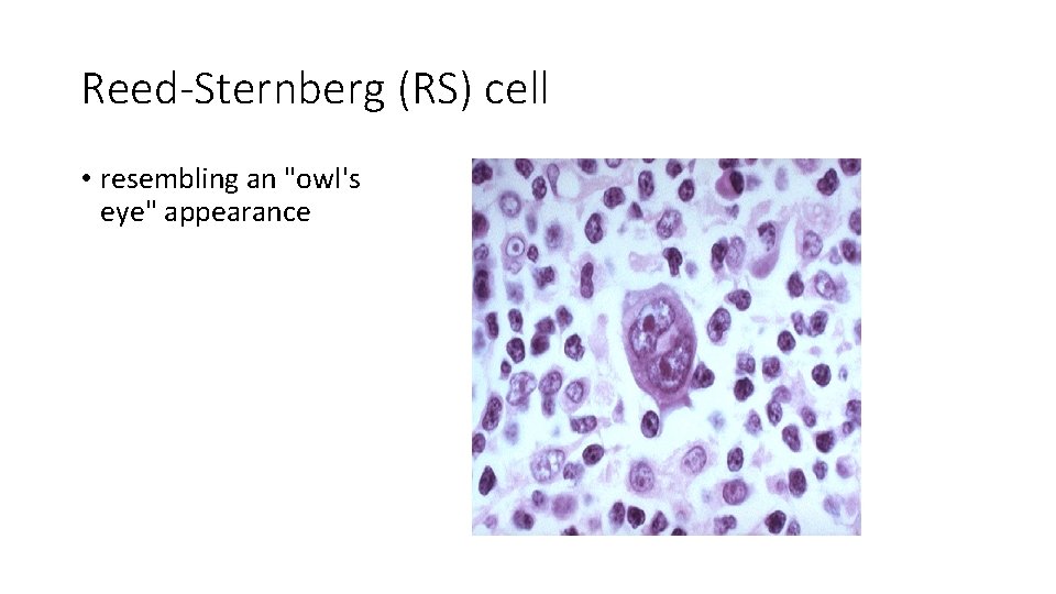Reed-Sternberg (RS) cell • resembling an "owl's eye" appearance 