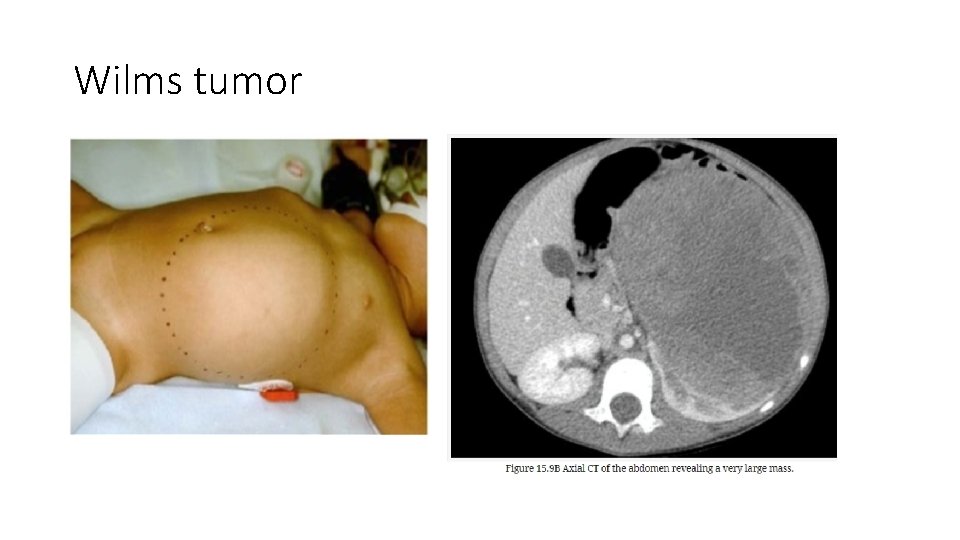 Wilms tumor 