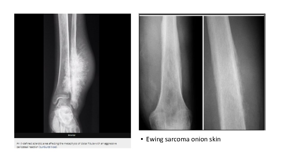  • Ewing sarcoma onion skin 