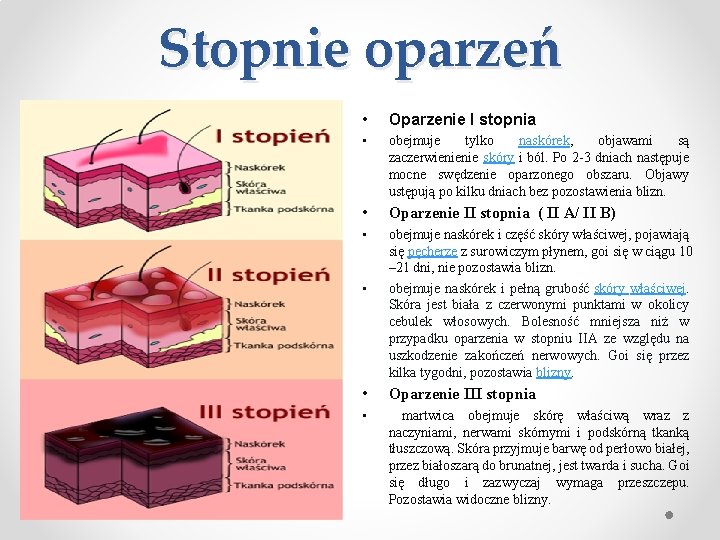 Stopnie oparzeń • Oparzenie I stopnia • obejmuje tylko naskórek, objawami są zaczerwienienie skóry