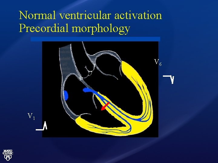 Normal ventricular activation Precordial morphology V 6 V 1 