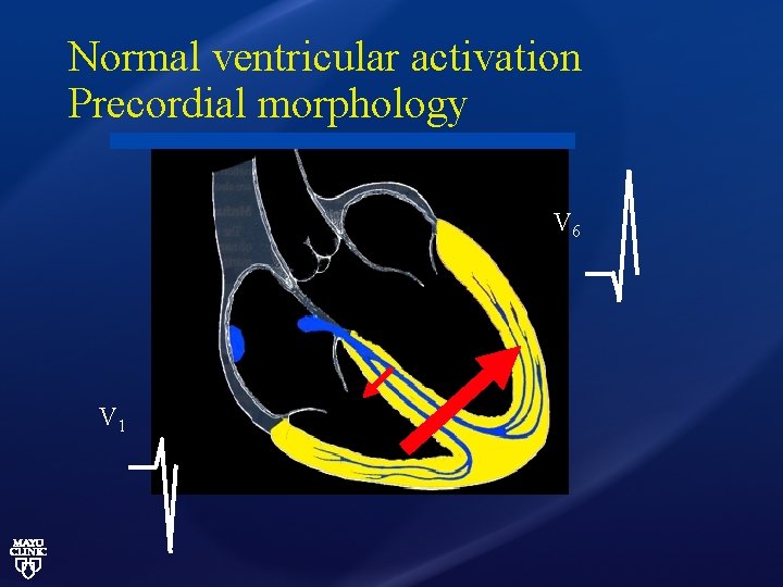 Normal ventricular activation Precordial morphology V 6 V 1 