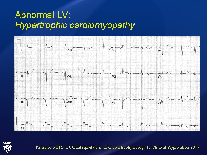 Abnormal LV: Hypertrophic cardiomyopathy Kusumoto FM. ECG Interpretation: From Pathophysiology to Clinical Application 2009