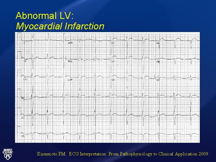Abnormal LV: Myocardial Infarction Kusumoto FM. ECG Interpretation: From Pathophysiology to Clinical Application 2009