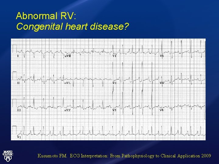 Abnormal RV: Congenital heart disease? Kusumoto FM. ECG Interpretation: From Pathophysiology to Clinical Application