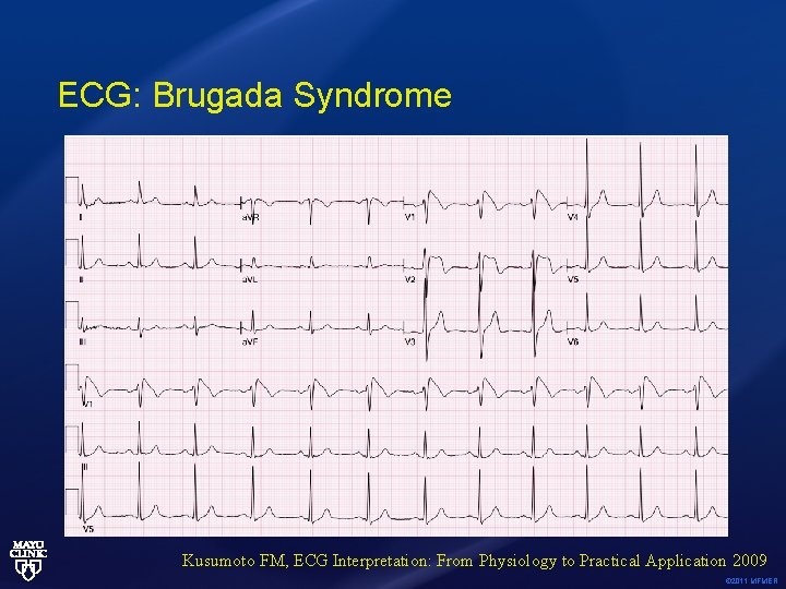 ECG: Brugada Syndrome Kusumoto FM, ECG Interpretation: From Physiology to Practical Application 2009 ©