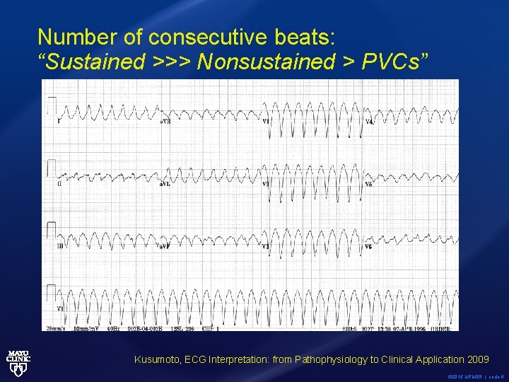 Number of consecutive beats: “Sustained >>> Nonsustained > PVCs” Kusumoto, ECG Interpretation: from Pathophysiology