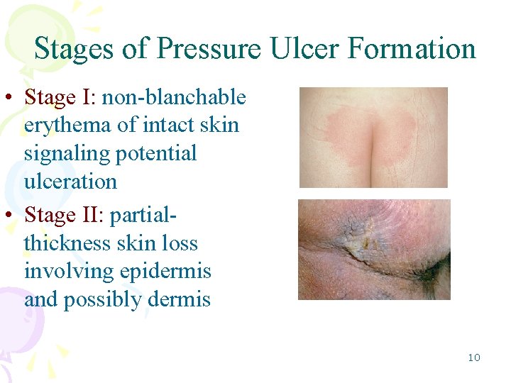 Stages of Pressure Ulcer Formation • Stage I: non-blanchable erythema of intact skin signaling